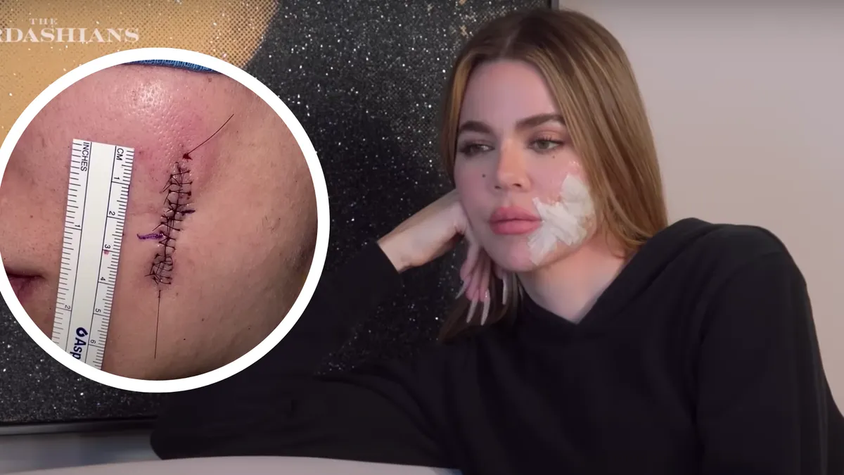 khloe-kardashian-melanoma-644badb4958a5